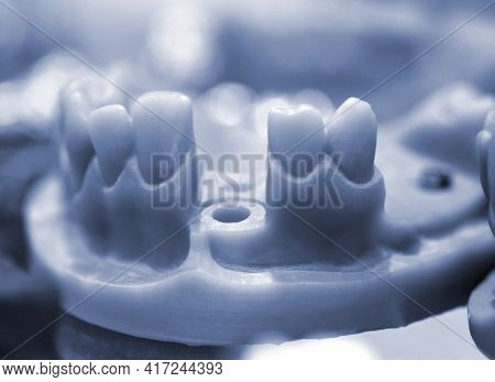 Collapsible Jaw Model With Teeth And Holes For The Implant Crown Abutment