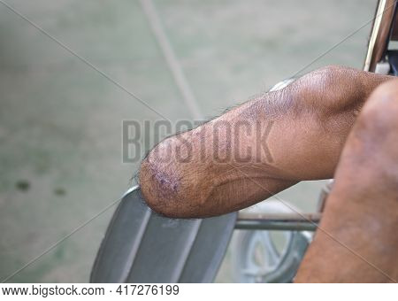 Below Knee Amputee Stump