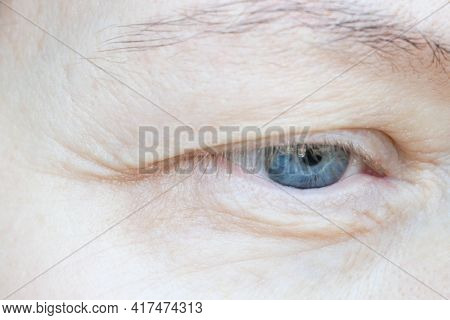Middle Aged Female's Eye With Drooping Eyelid. Ptosis Is A Drooping Of The Upper Eyelid, Lazy Eye. C