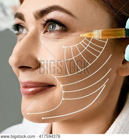 Plasmolifting Skin. Middle-aged Woman With Lifting Arrows On Her Face During Plasma Therapy