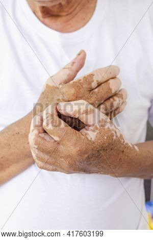 Close-up Vitiligo On Skin Hands Of Old People. Medical Condition Causing Depigmentation Of Patches O