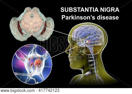 Black Substance Of The Midbrain In Parkinson's Disease, 3d Illustration Showing Decrease Of Its Volu