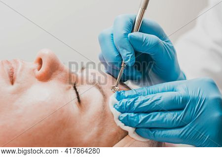 Mechanical Facial Cleansing, Skin Cleansing Procedure From Surface And Deep Impurities.