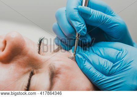 Mechanical Facial Cleansing, Skin Cleansing Procedure From Surface And Deep Impurities.