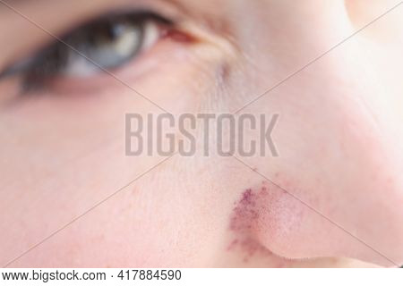 Red Cyanotic Rash On Woman Nose Closeup