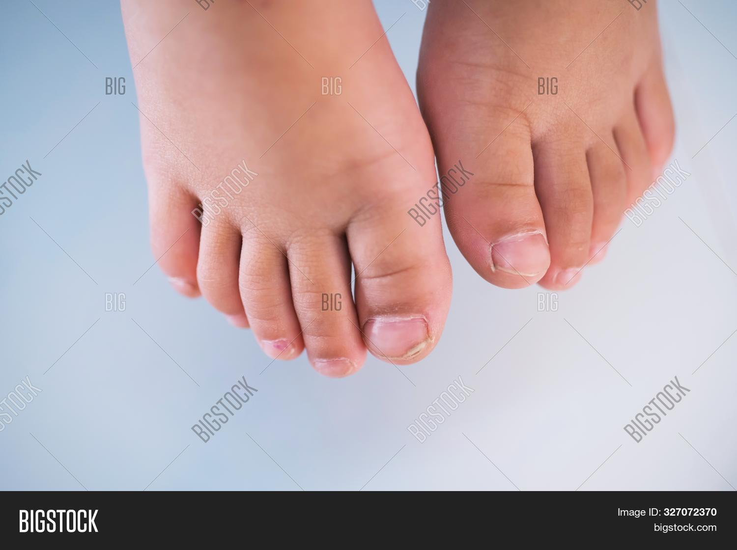 Children Foot Cracked Image & Photo (Free Trial) Bigstock