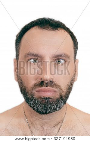 A Man With Strabismus. Orthoptics. Ophthalmology Concept. Medical Desease