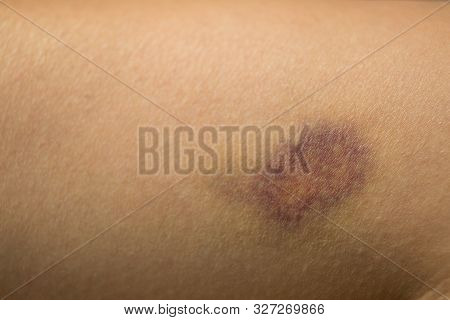 Closeup Of Large Bruise On Woman Leg Skin