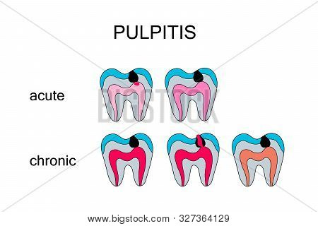 Types Of Pulpitis Hand Drawn Vector Illustration In Cartoon Comic Style Acute Chronic