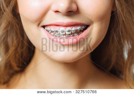 Orthodontic Treatment. Dental Care Concept. Beautiful Woman Healthy Smile Close Up. Closeup Ceramic 