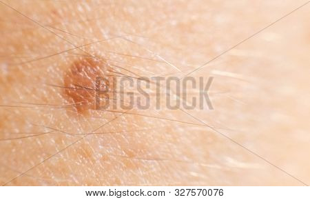 Small Mole Nevus On Human Skin, Carcinoma. Background, Macro