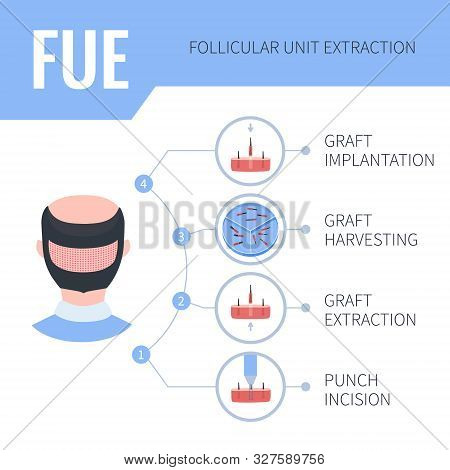 Fue Hair Transplantation Medical Infographics For Men