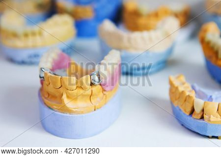 Implantation And Manufacture Of Dental Prostheses. Man's Jaw With Teeth On The Table In The Dental L