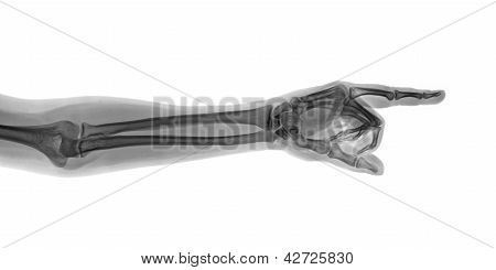 Pegende X-ray hånd