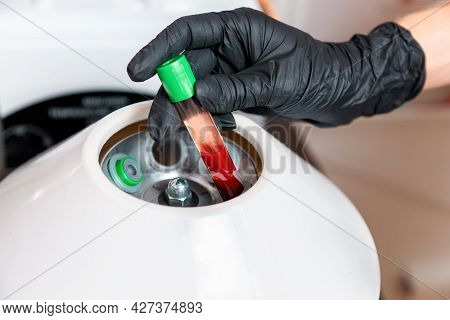 Plasmolifting. Preparation Of Blood For Beauty Injections. The Cosmetologist Puts A Test Tube With B
