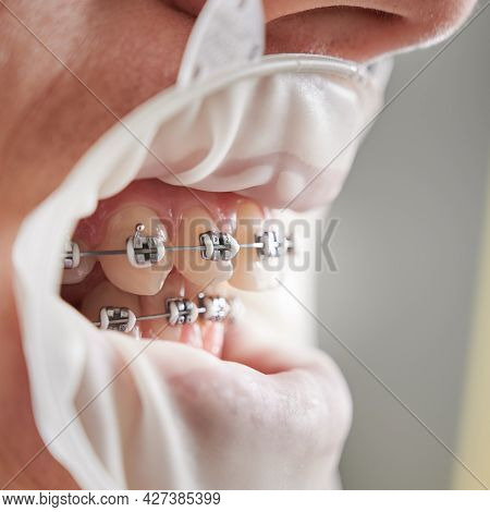 Close Up Of Man With Sterile Rubber Dam Cheek Retractor In Mouth Showing Teeth With Wired Metal Brac