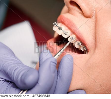 Close Up Of Dentist Hand In Serial Glove Putting Elastic Rubber Band On Patient Brackets. Woman With