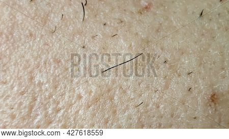 Closeup Of Caucasian Skin With Ingrown Hair And Man Short Beard. Close Up Of Caucasian Skin With Man