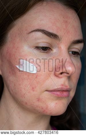Papulopustular Form Of Rosacea, Patient's Face With Moisturizer Close-up. No Retouching
