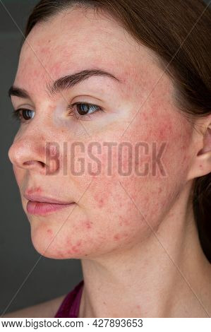 Papulopustular Form Of Rosacea, Skin Erythema, Acne On The Face