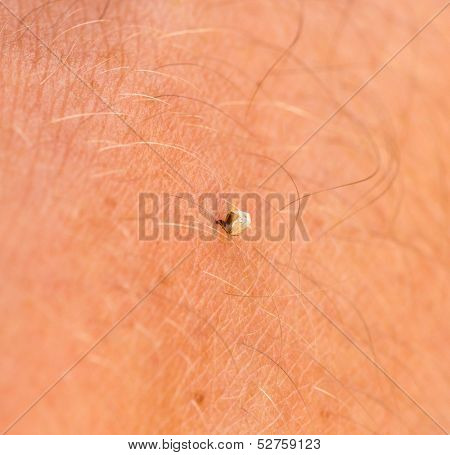 Selective focus of bee sting stuck in human skin