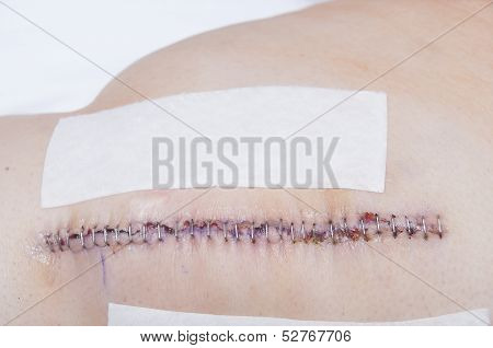 Knee Replacement Staples