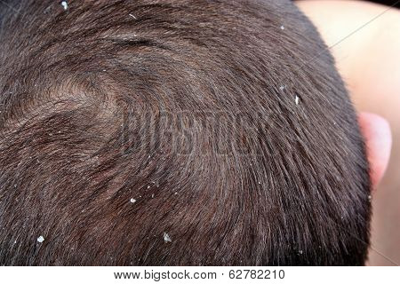 Dandruff In The Hair