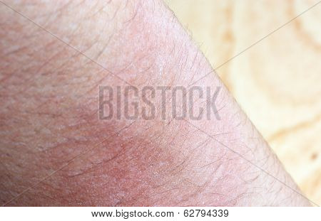 Allergic Rash Dermatitis Eczema Skin