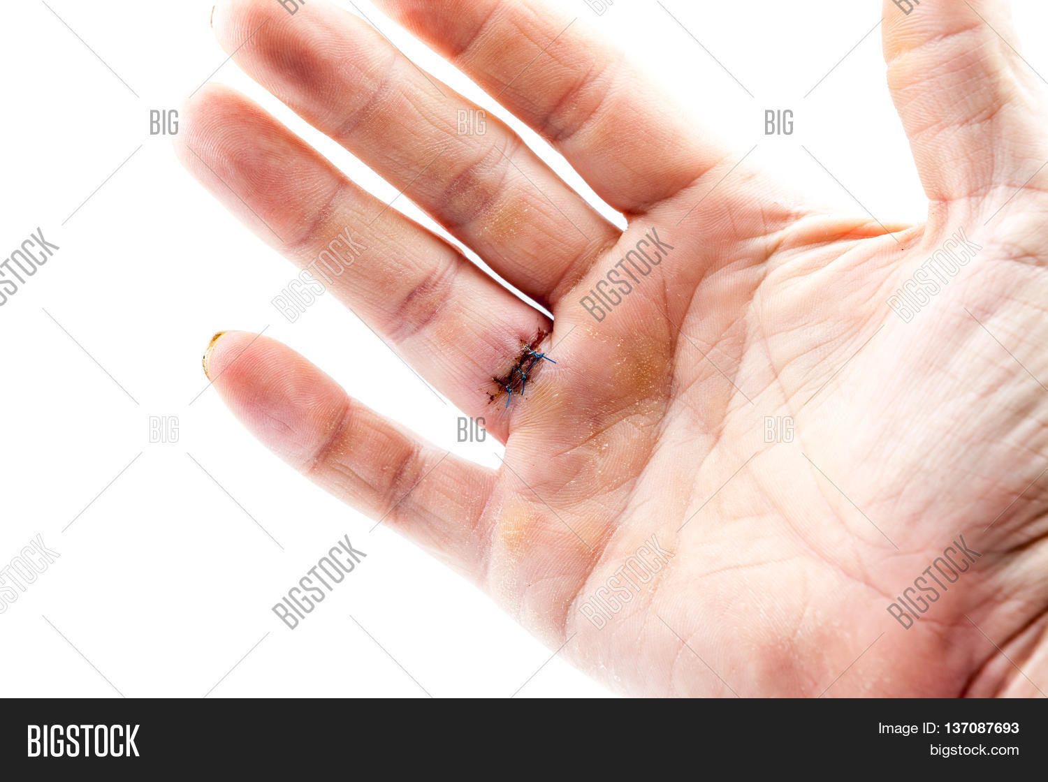 After Removal Cyst Finger Hand This Image & Photo Bigstock