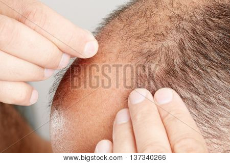 Hair loss.