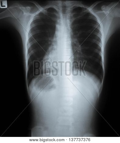 Film chest PA upright in accident case : Normal