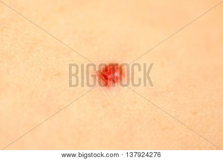 Cherry Angioma or Campbell de Morgan spots