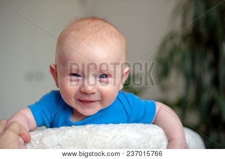 Traces Of Diathesis On The Head And Cheeks Of The Baby.