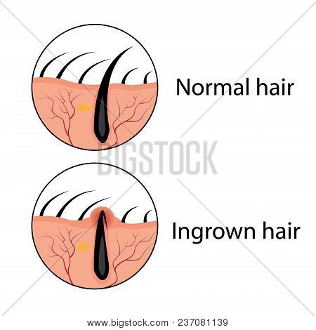 Normal And Ingrown Hair Vector Illustration. Skincare Problem.