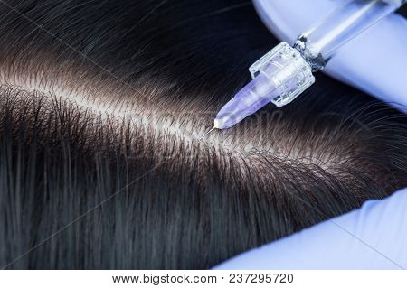 Procedure Of Mesotherapy. The Doctor Cosmetologist Makes The Procedure Of Mesotherapy In Woman's Hea