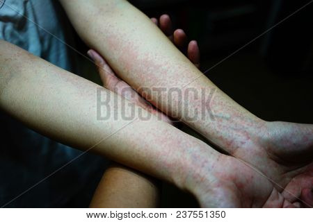 Urticaria Or Hives On The Forearms With Itchy Bumps And Red Skin Causes By Food Allergies, Lack Of R