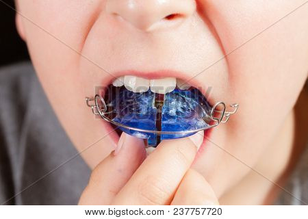 Child with orthodontic appliance close-up