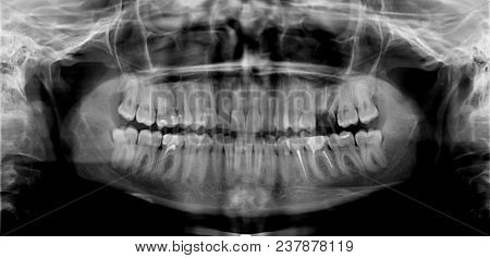 Original Black White X-ray Teeth Scan Mandible. Panoramic Negative Image Facial Of Young Adult Male.