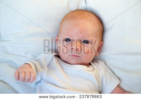 Allergies, Atopic Dermatitis On The Face Of A Baby