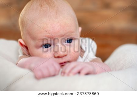 Allergies, Atopic Dermatitis On The Face Of A Baby