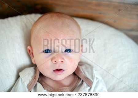 Allergies, Atopic Dermatitis On The Face Of A Baby