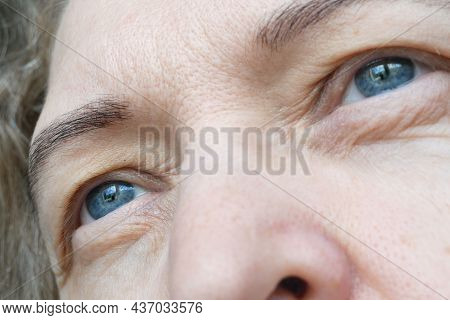 Middle Aged Female's Eye With Drooping Eyelid. Ptosis Is A Drooping Of The Upper Eyelid, Lazy Eye. C
