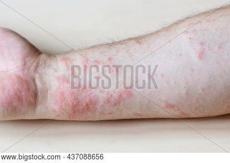 Sample Of Allergic Contact Dermatitis - Itchy Rash On Side Of Forearm Close Up