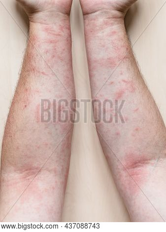 Sample Of Allergic Contact Dermatitis - Male Arms With Itchy Red Rash