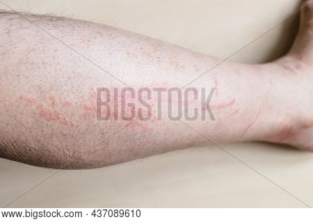 Sample Of Allergic Contact Dermatitis - Side Of Male Shin With Itchy Red Rash