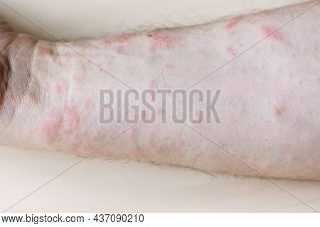 Sample Of Allergic Contact Dermatitis - Papules On Inner Side Of Forearm Close Up