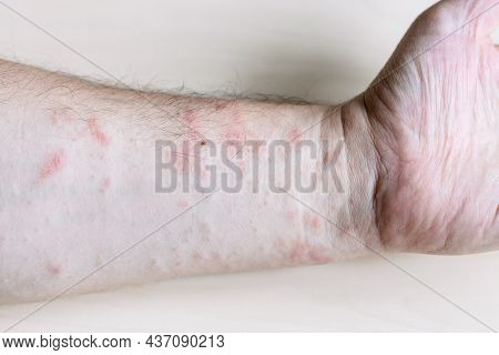 Sample Of Allergic Contact Dermatitis - Pink Rash On Inner Side Of Forearm Close Up