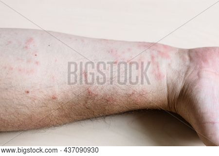 Sample Of Allergic Contact Dermatitis - Skin Inflammation On Inner Side Of Forearm Close Up