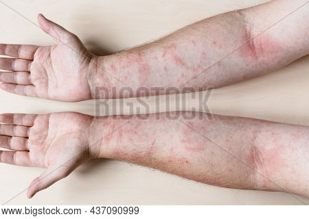 Sample Of Allergic Contact Dermatitis - Male Arms With Inflamed Skin