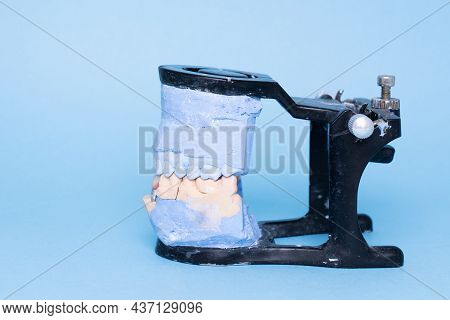 Tooth Recovery With Implant. Veneers And Crowns On Gypsum Dental Artificial Jaw On Blue Background. 